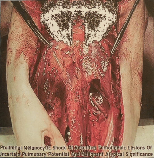 Carcinomas Of Unknown Primary Origin : Proliferal Melanocytic Shock of Recurring Tumorigenic Lesions of Uncertain Pulmonary Potential and M